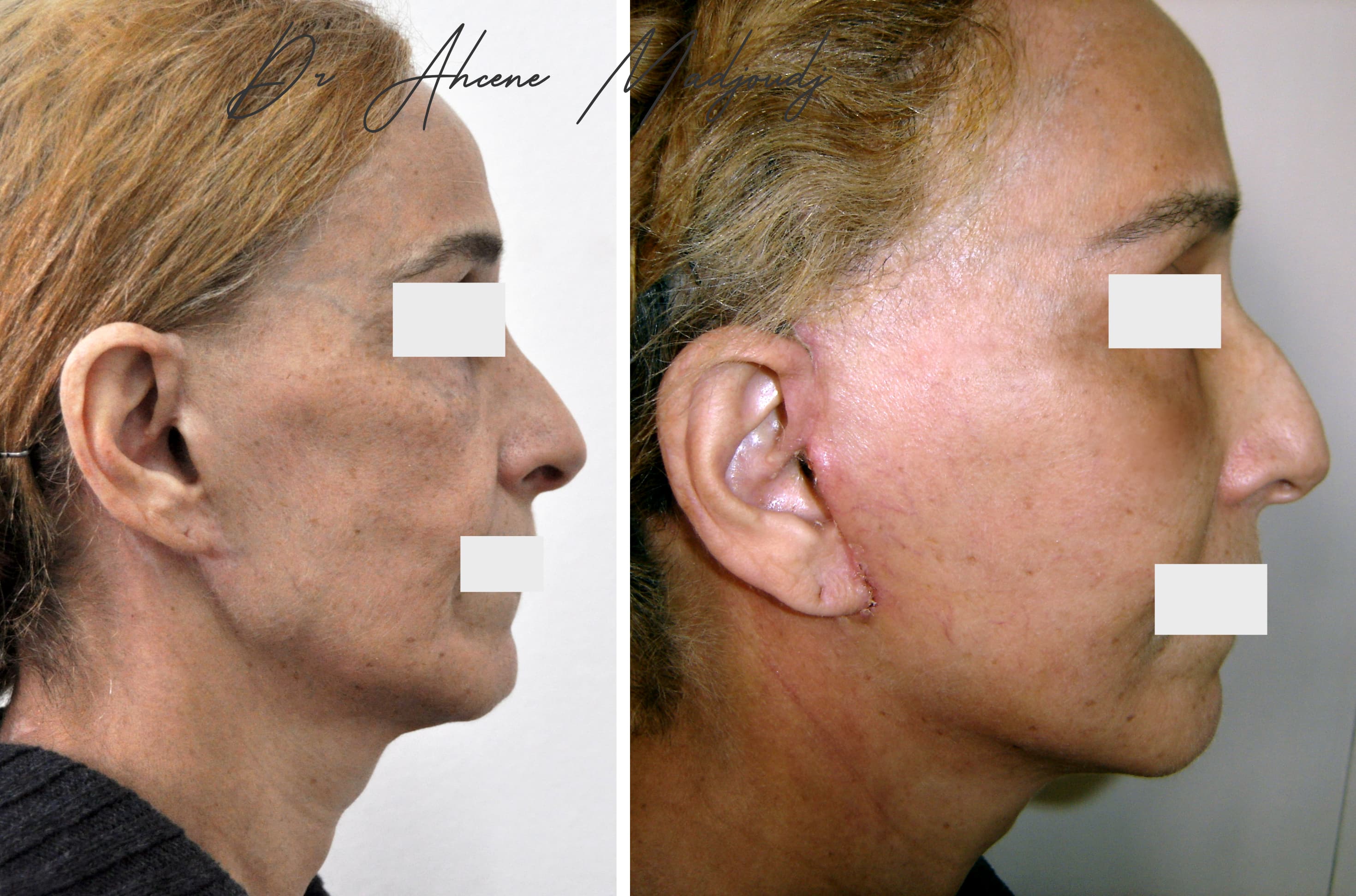 Lifting du Visage en algérie 1 an après