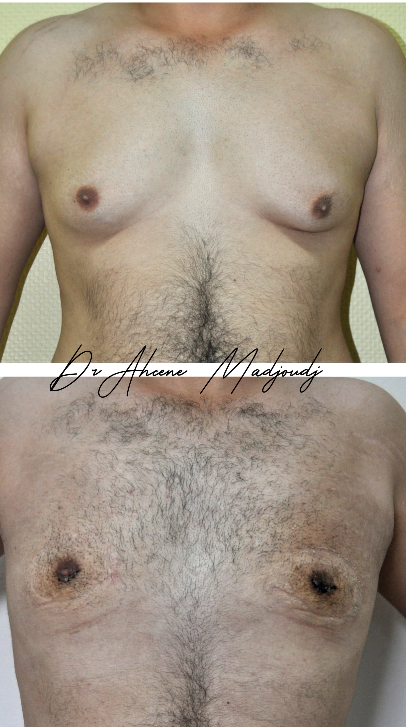 Traitement de la Gynécomastie modérée en Algérie