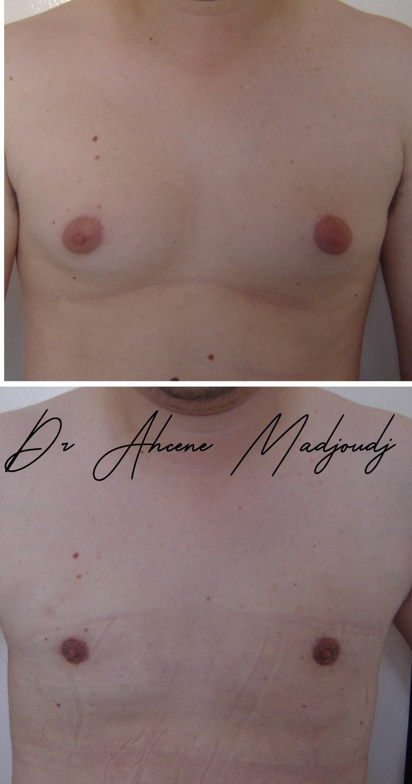 Traitement de la Gynécomastie modérée en Algérie