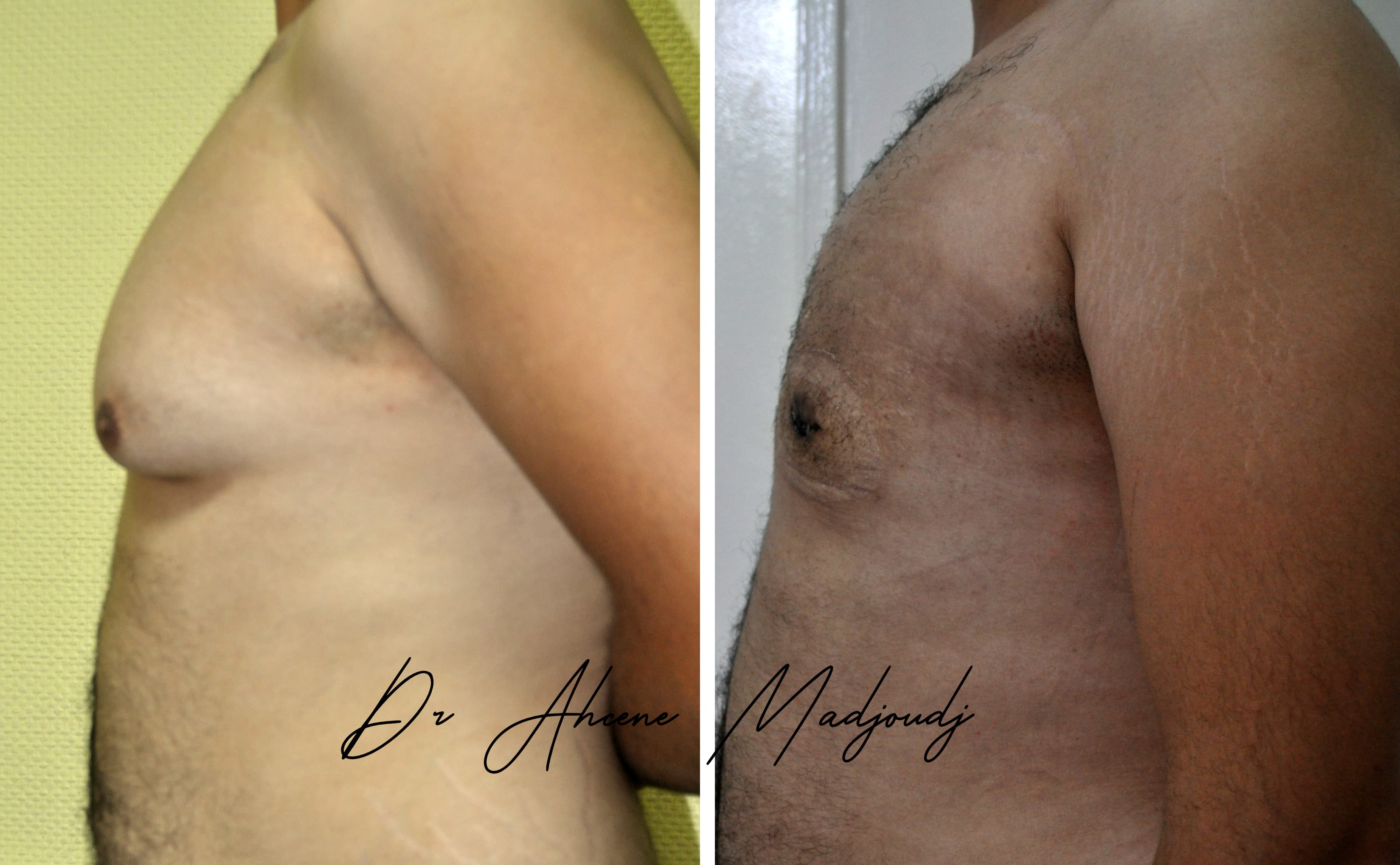 Traitement de la Gynécomastie modérée en Algérie