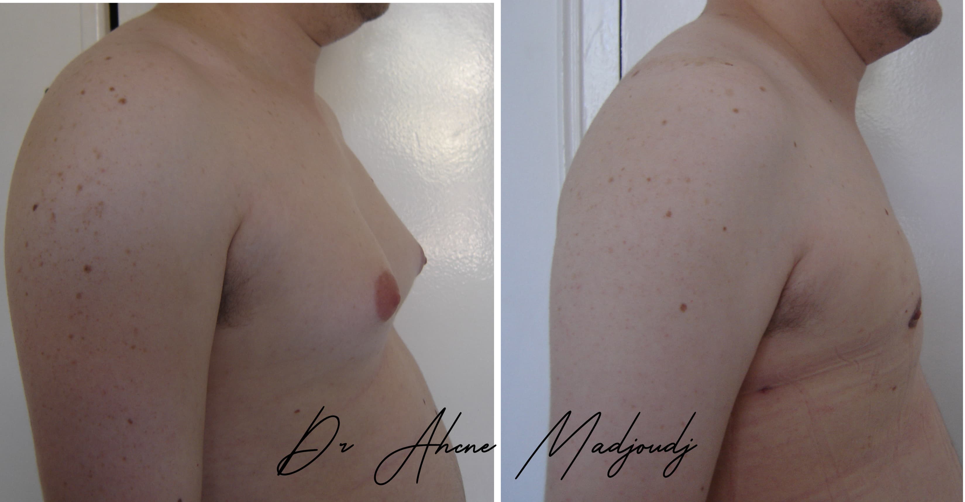 Traitement de la Gynécomastie modérée en Algérie