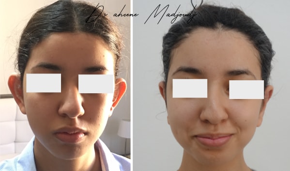 oreilles decolles femme.jpg