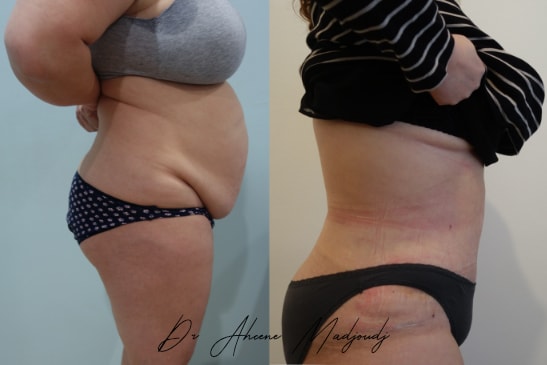abdominoplastie-9.jpg