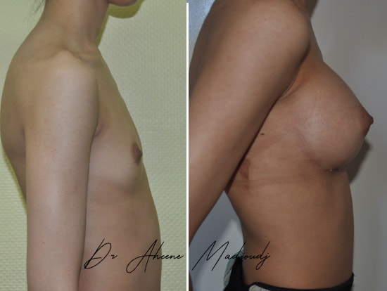 Augmentation Mammaire avec Implants à Alger , algerie par le docteur Madjoudj