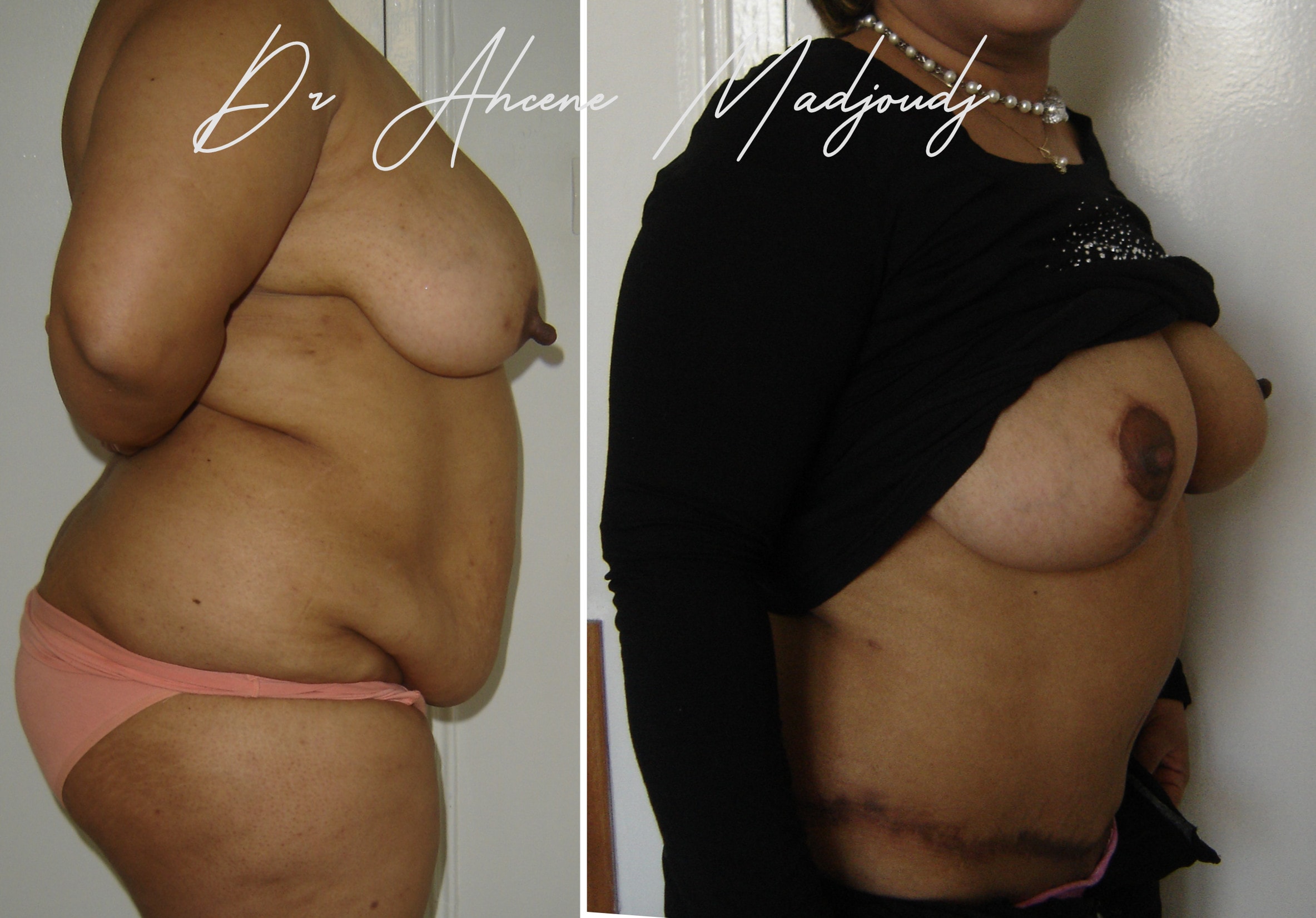 Chirurgie Post-Grossesse ou Mommy Makeover à Algerie