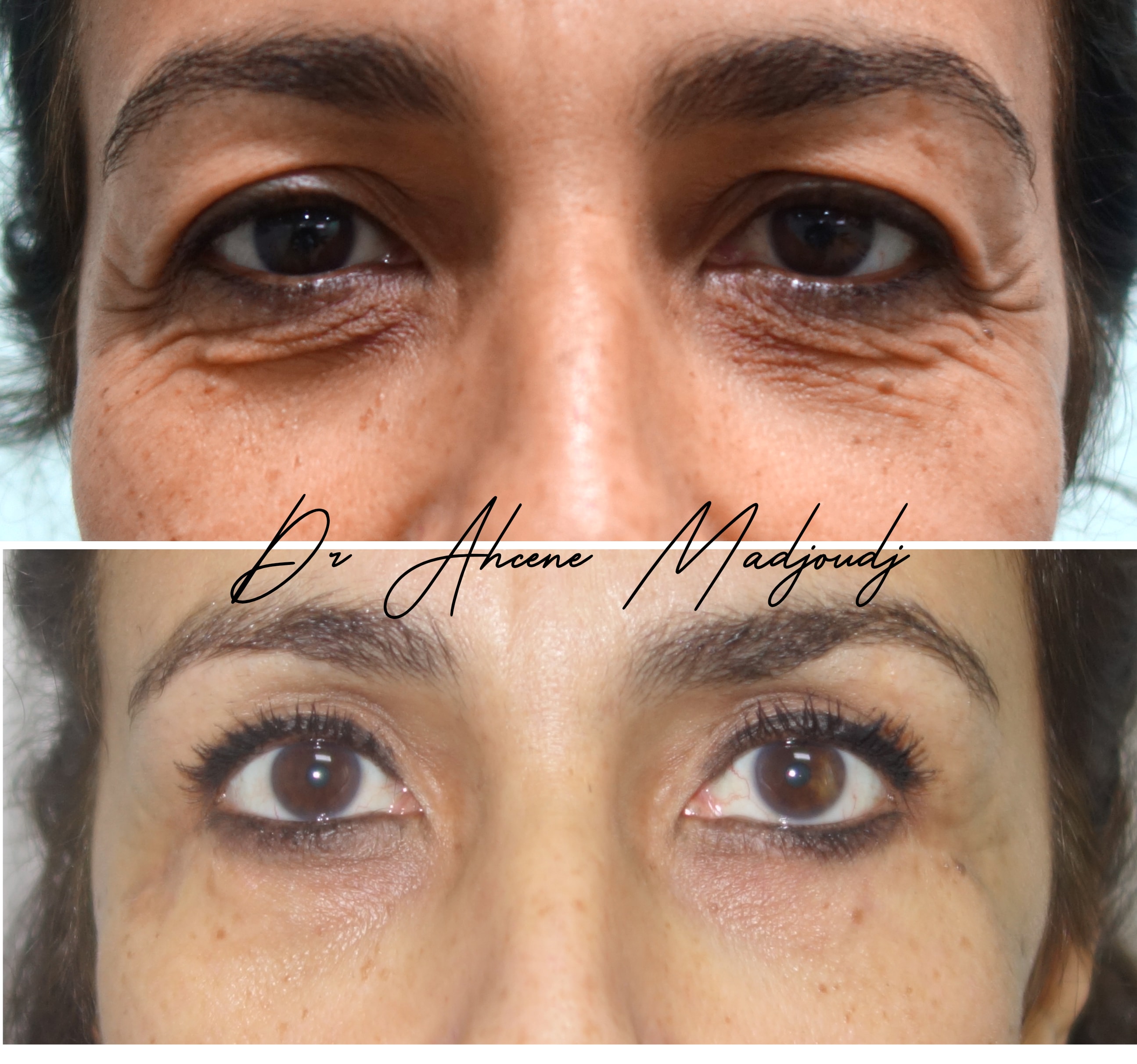 Blépharoplastie à Alger par le Dr Madjoudj 