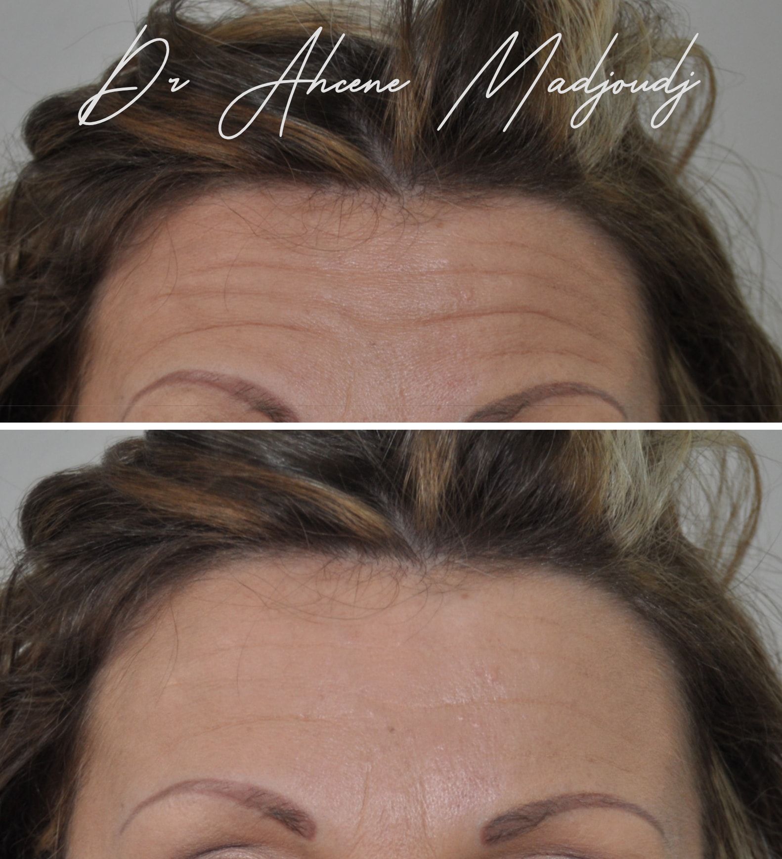 Le Botox à Alger, Algérie 