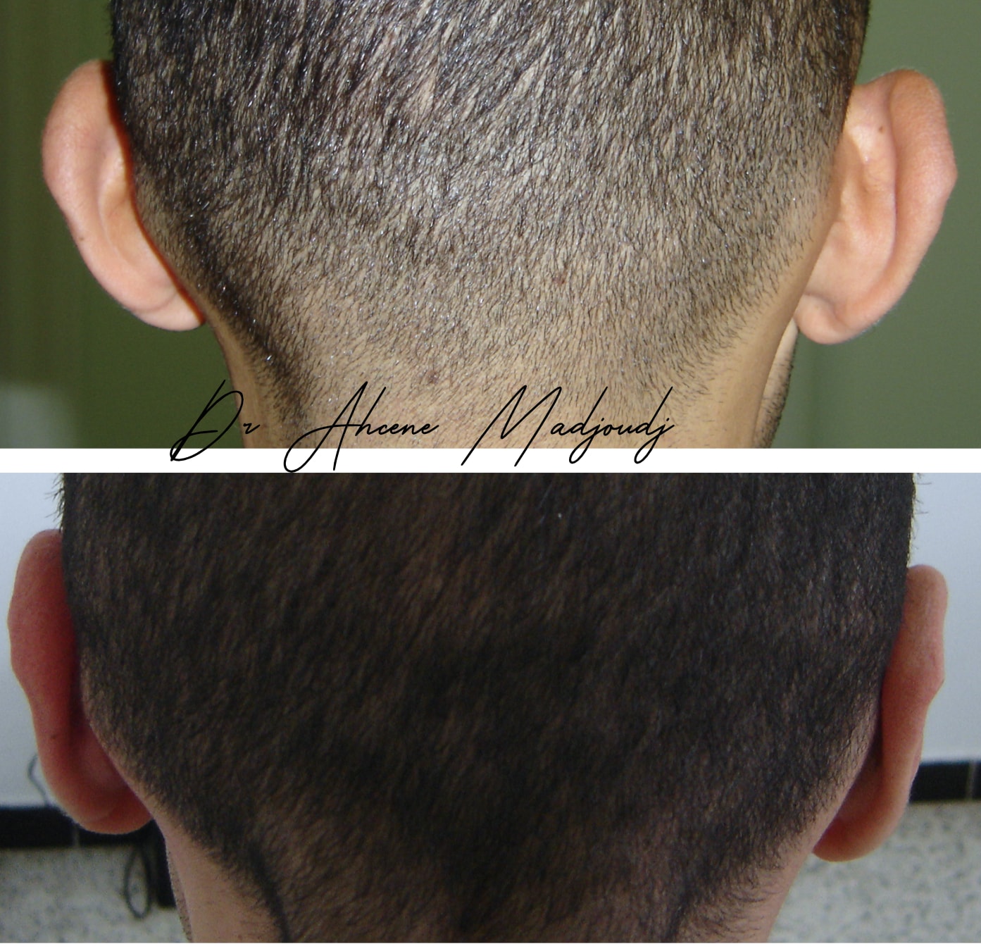 Otoplastie à Alger, Algerie par le Dr Madjoudj 