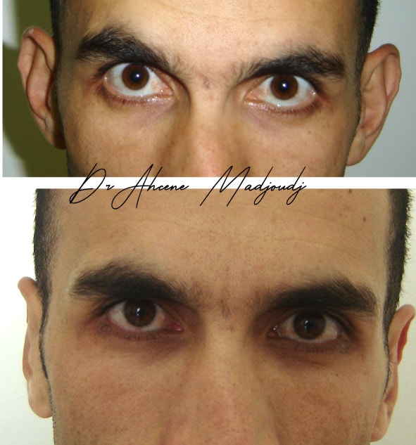 Otoplastie à Alger, Algerie par le Dr Madjoudj 