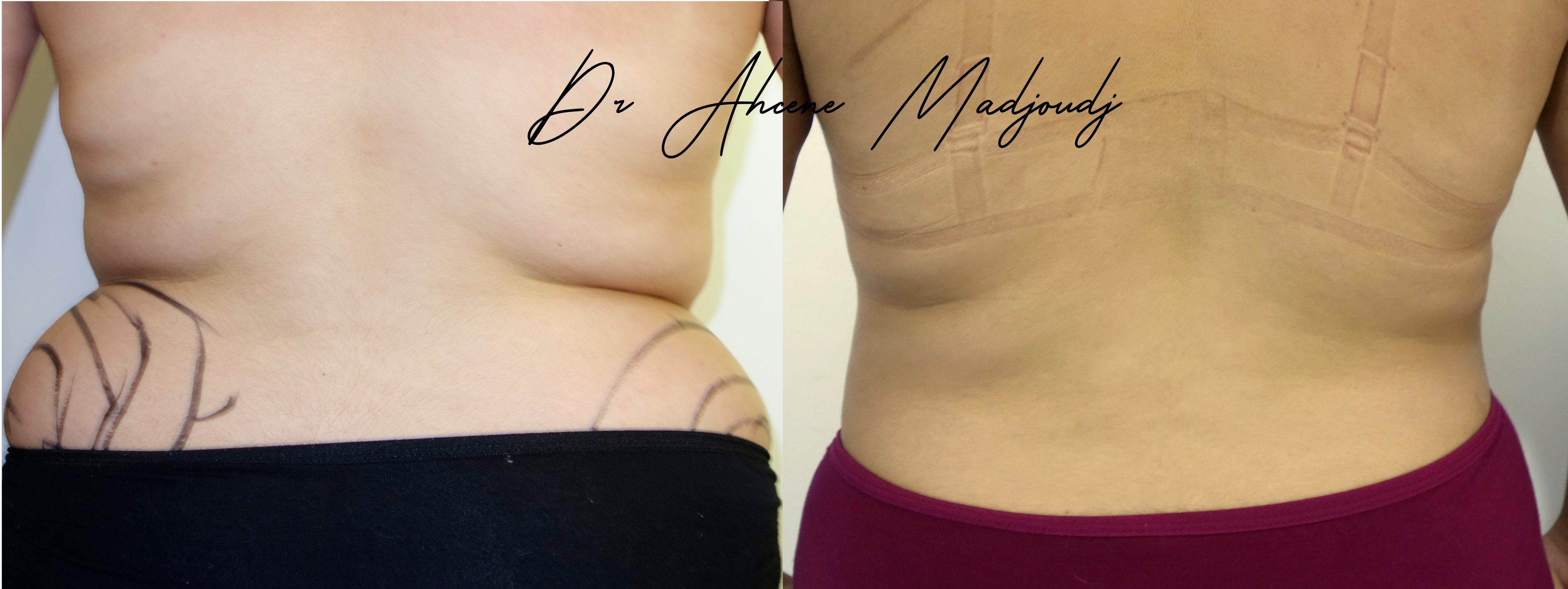 Chirurgie Post-Grossesse ou Mommy Makeover à Algerie