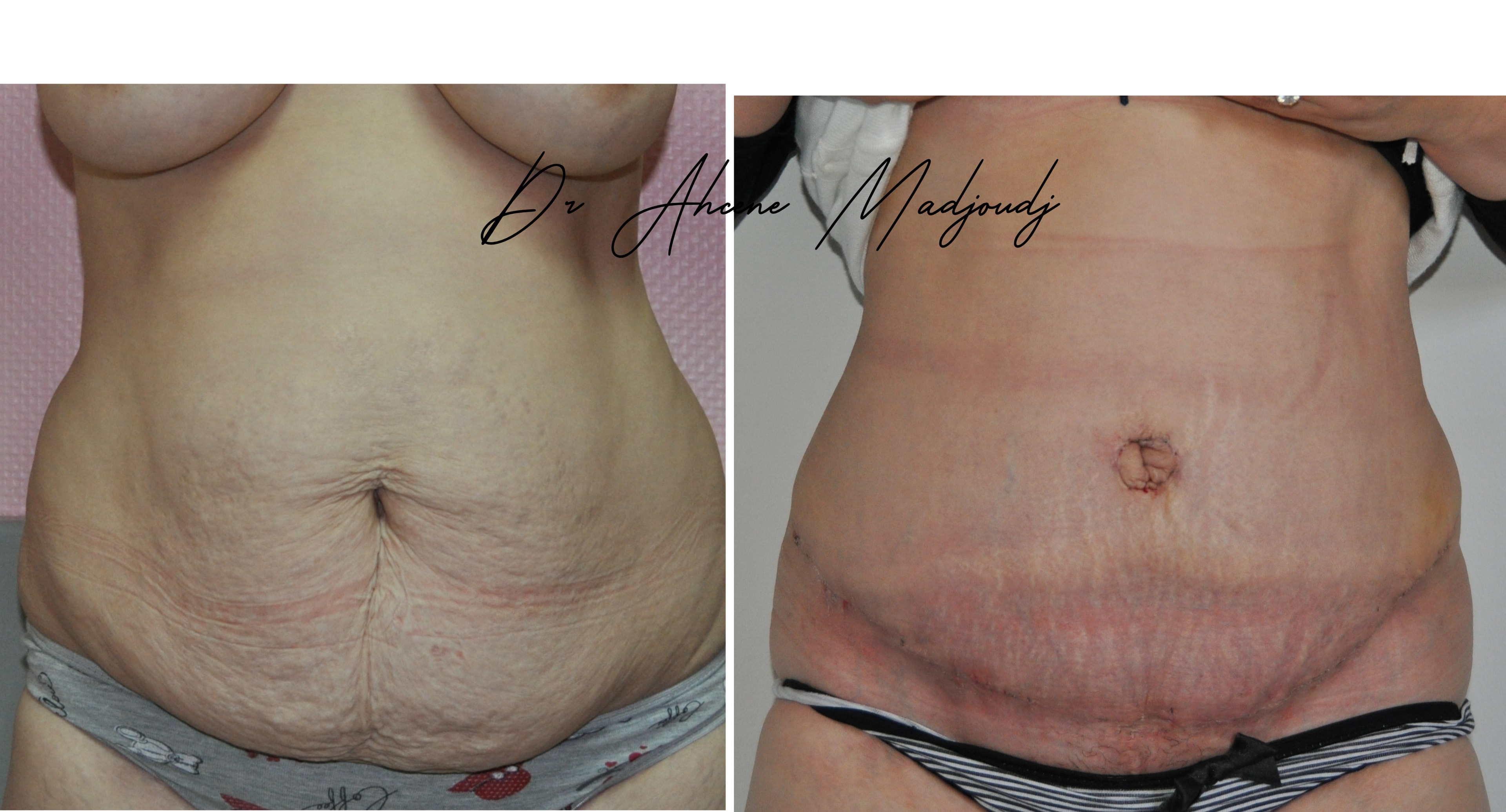 Abdominoplastie à Alger , Algérie par le dr Madjoudj  4 mois après 