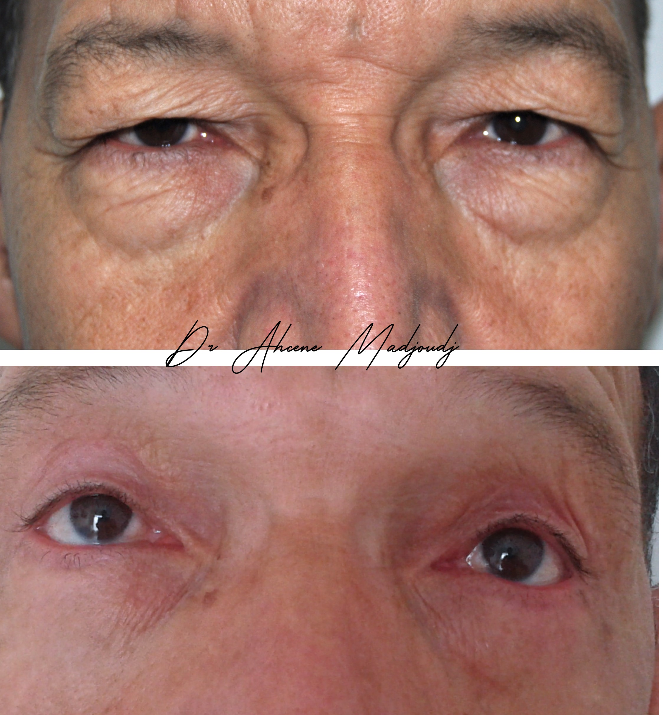 Blépharoplastie à Alger par le Dr Madjoudj |