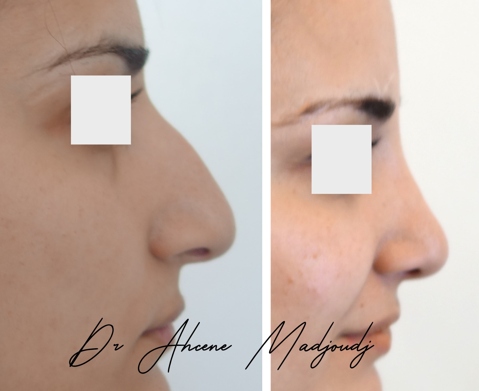rhinoplastie en Algerie  par le Dr Ahcène Madjoudj 