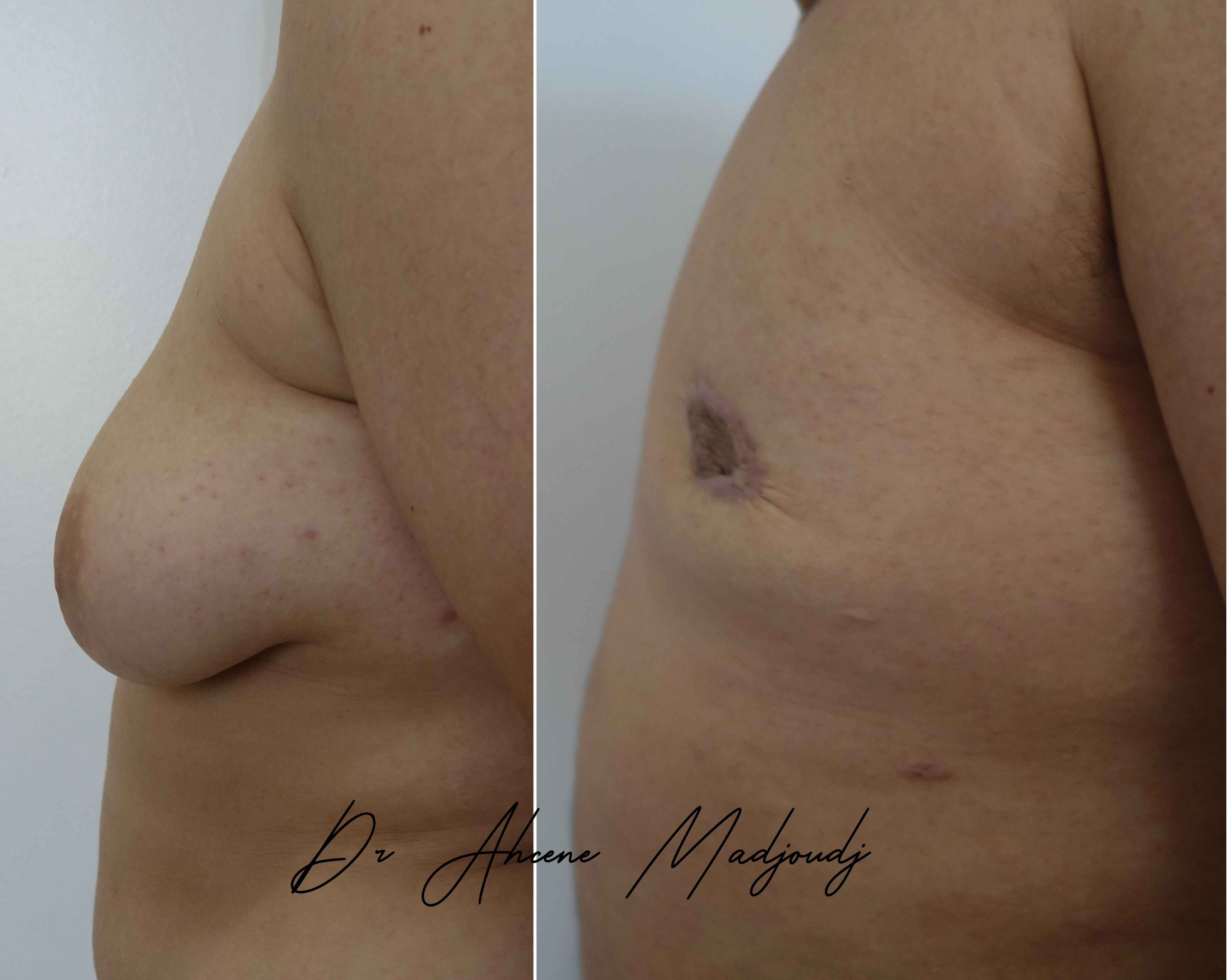 Traitement de la Gynécomastie sévère en Algérie