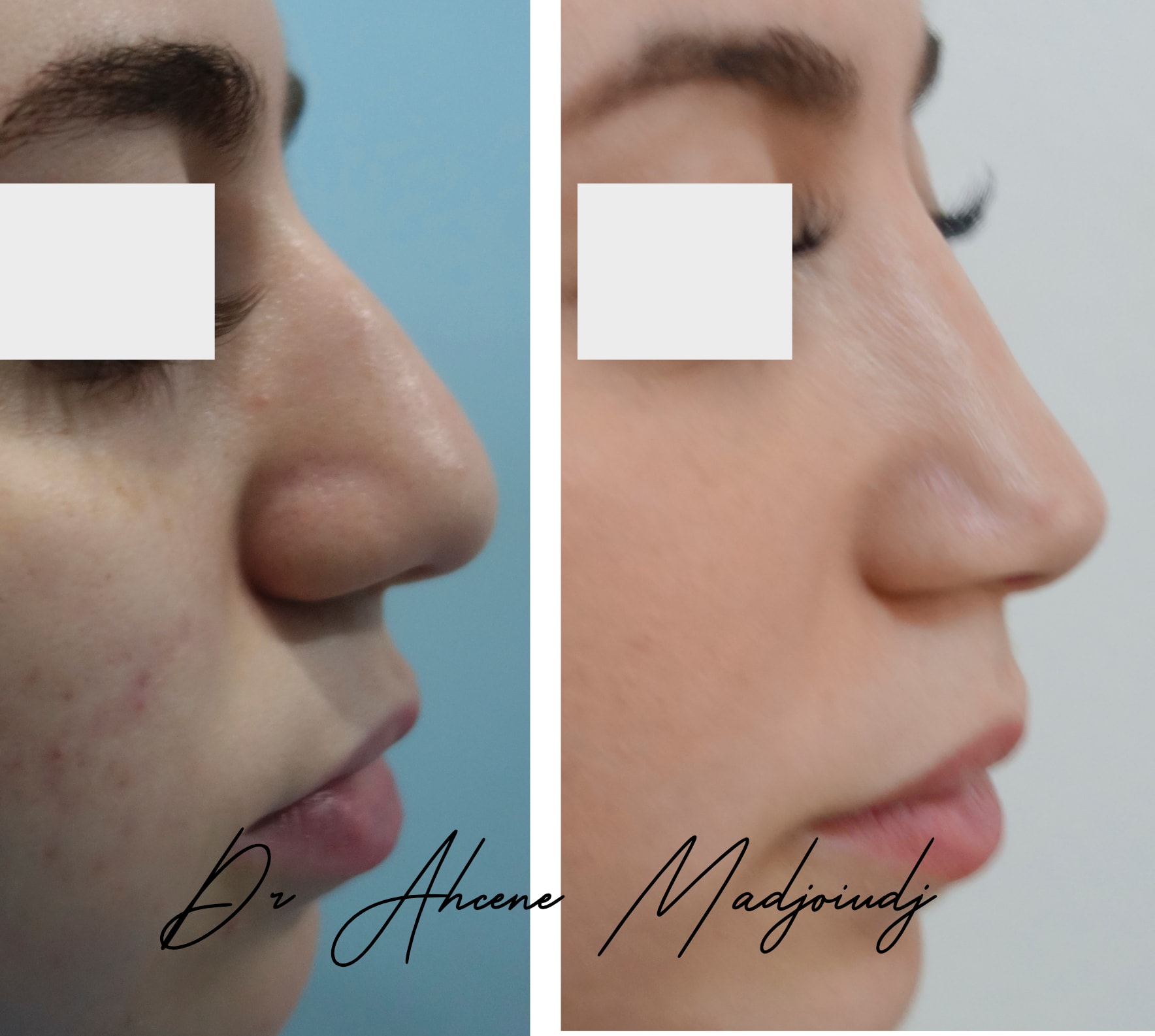 rhinoplastie en Algerie  par le Dr Ahcène Madjoudj 