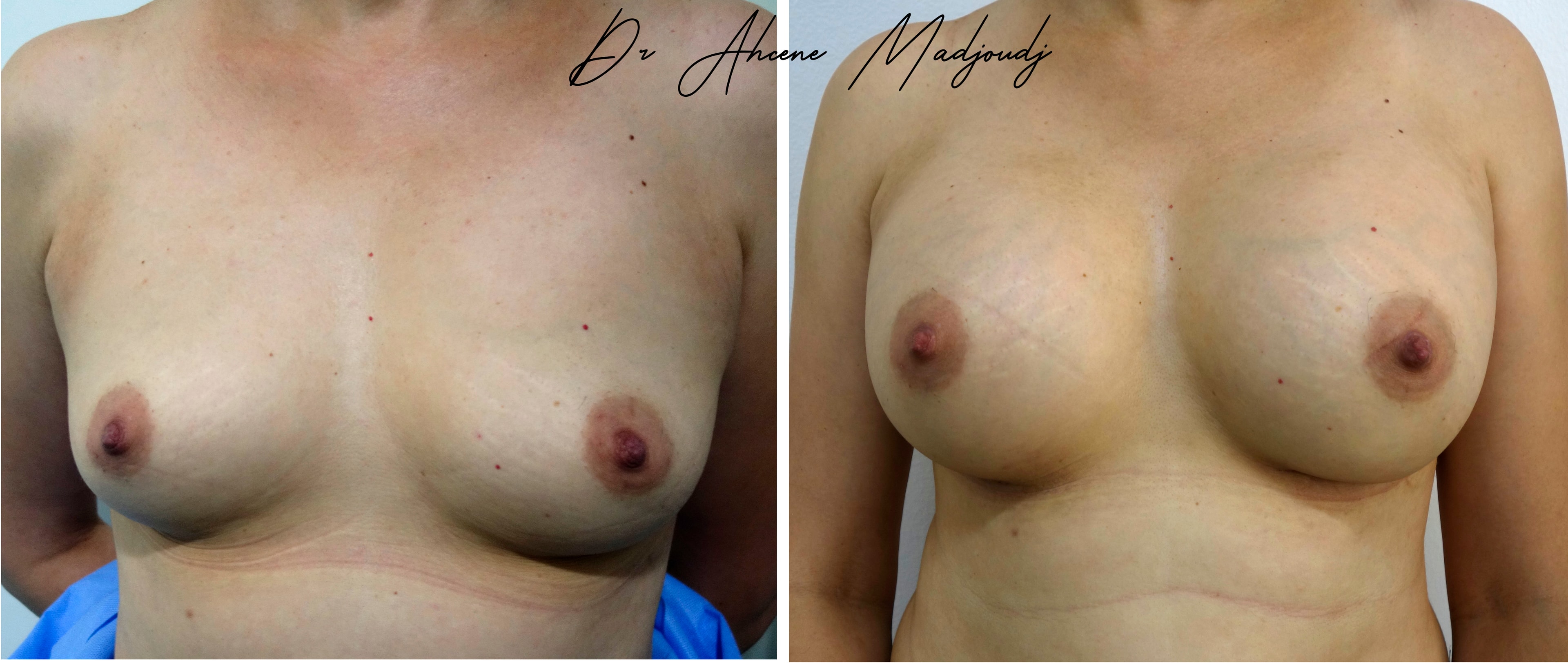 Augmentation Mammaire avec Implants à Alger , algerie par le docteur Madjoudj