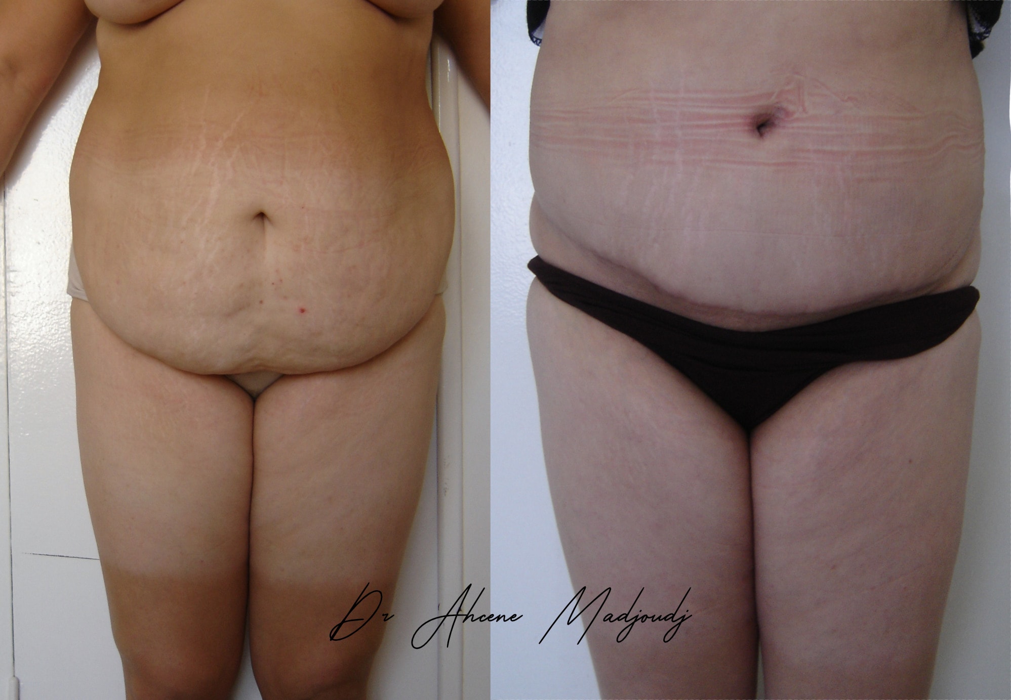 Abdominoplastie à Alger , Algérie par le dr Madjoudj  7 mois après 