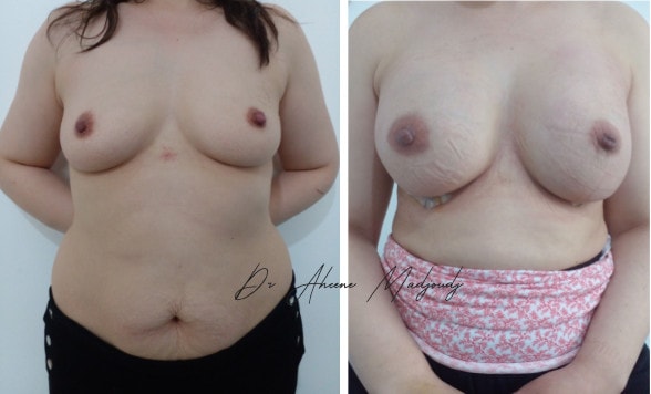 Augmentation Mammaire avec Implants à Alger , algerie par le docteur Madjoudj