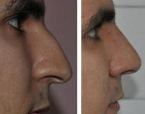 Rhinoplasty in Algeria or Bourbon Nose Surgery 
