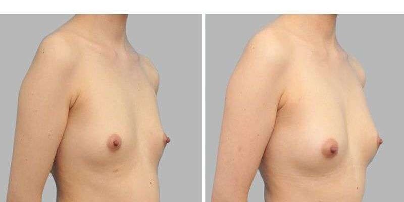 lipoffiling seins.jpg