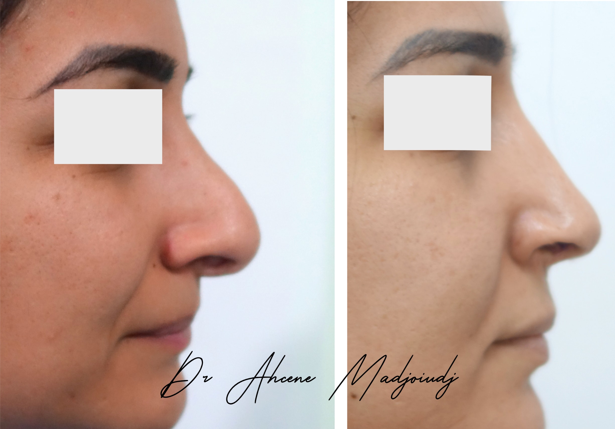 rhinoplastie en Algerie  par le Dr Ahcène Madjoudj 