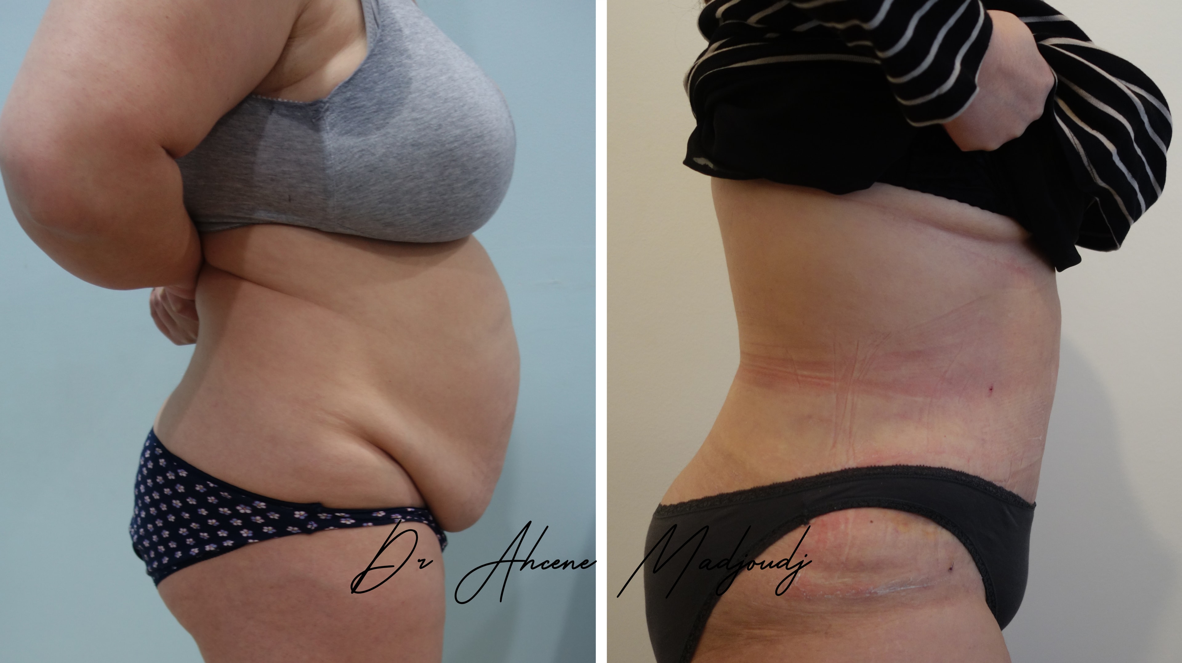 Abdominoplastie à Alger , Algérie par le dr Madjoudj