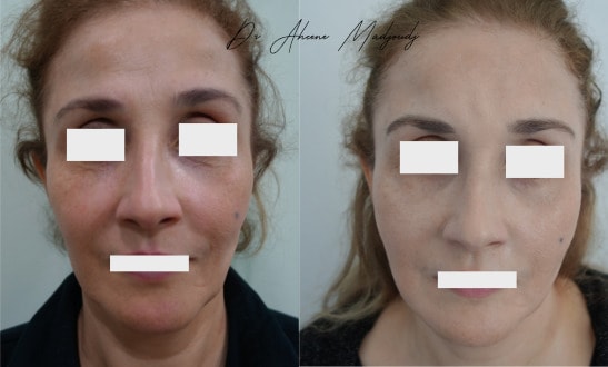 Lipofilling du Visage à Alger, Algerie