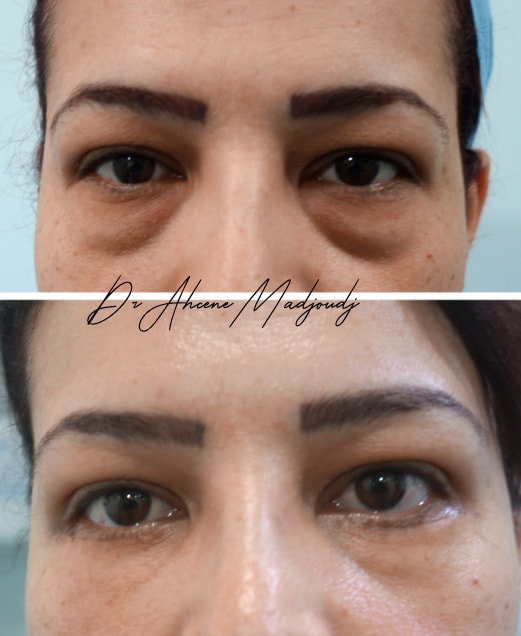 Blépharoplastie à Alger par le Dr Madjoudj |