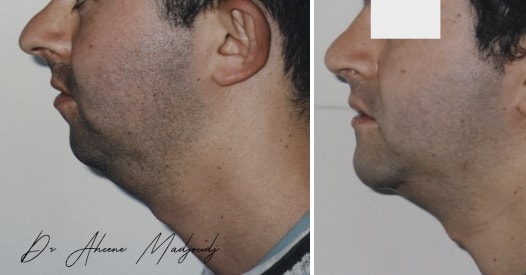 Génioplastie à Alger par le Dr Madjoudj | Chirurgie du Menton pour un Profil Harmonieux