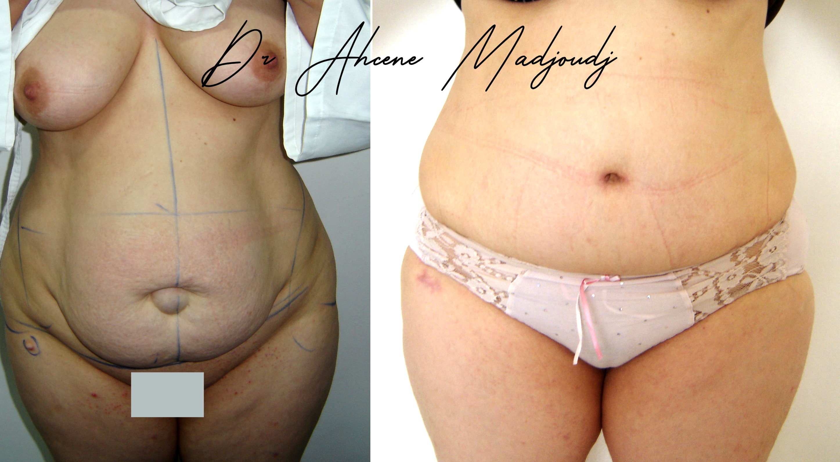 Liposuccion & Liposculpture à Alger par Le docteur Madjoudj