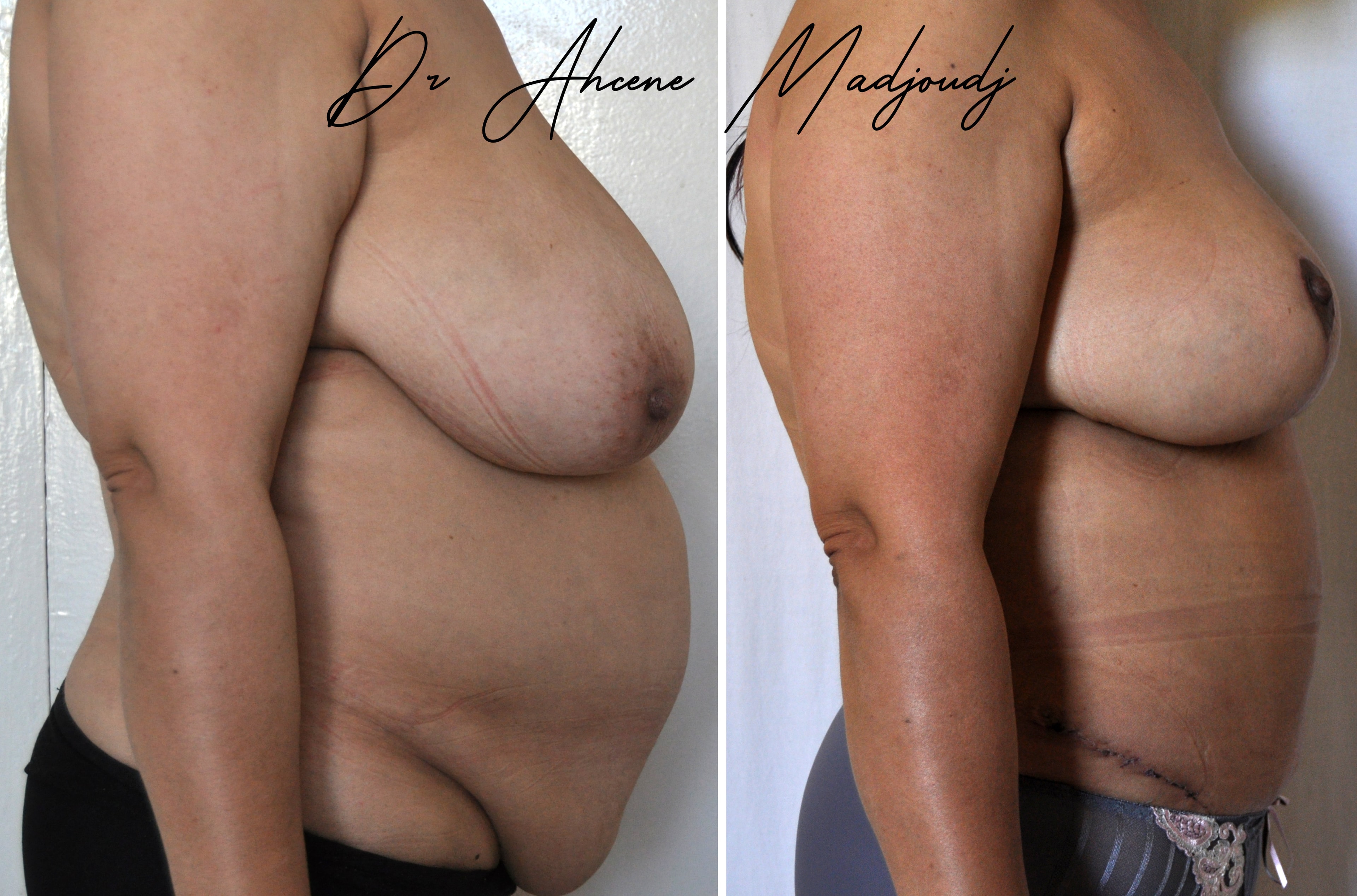 Chirurgie Post-Grossesse ou Mommy Makeover à Algerie