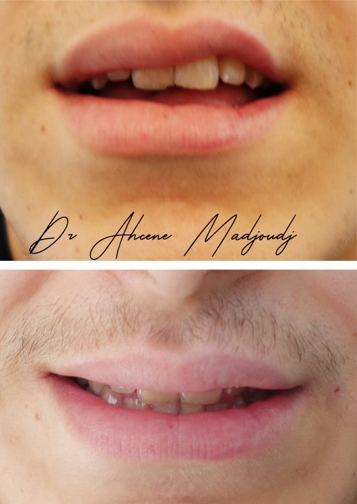 Acide Hyaluronique à Alger  par le docteur Madjoudj