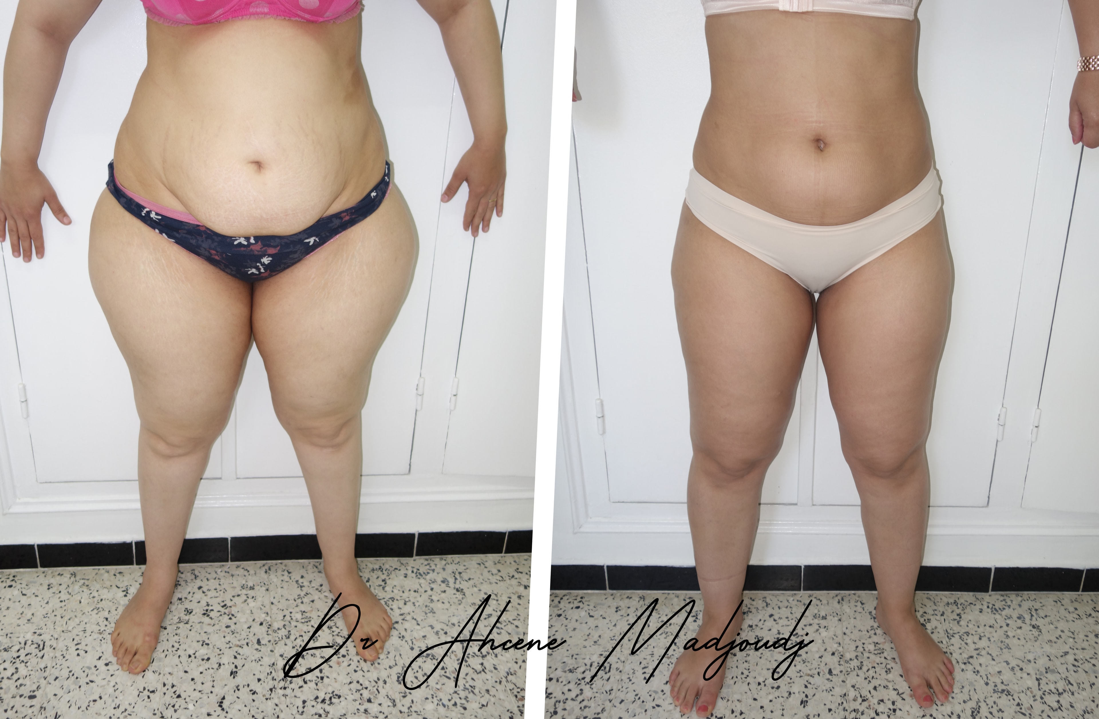 Liposuccion & Liposculpture à Alger par Le docteur Madjoudj