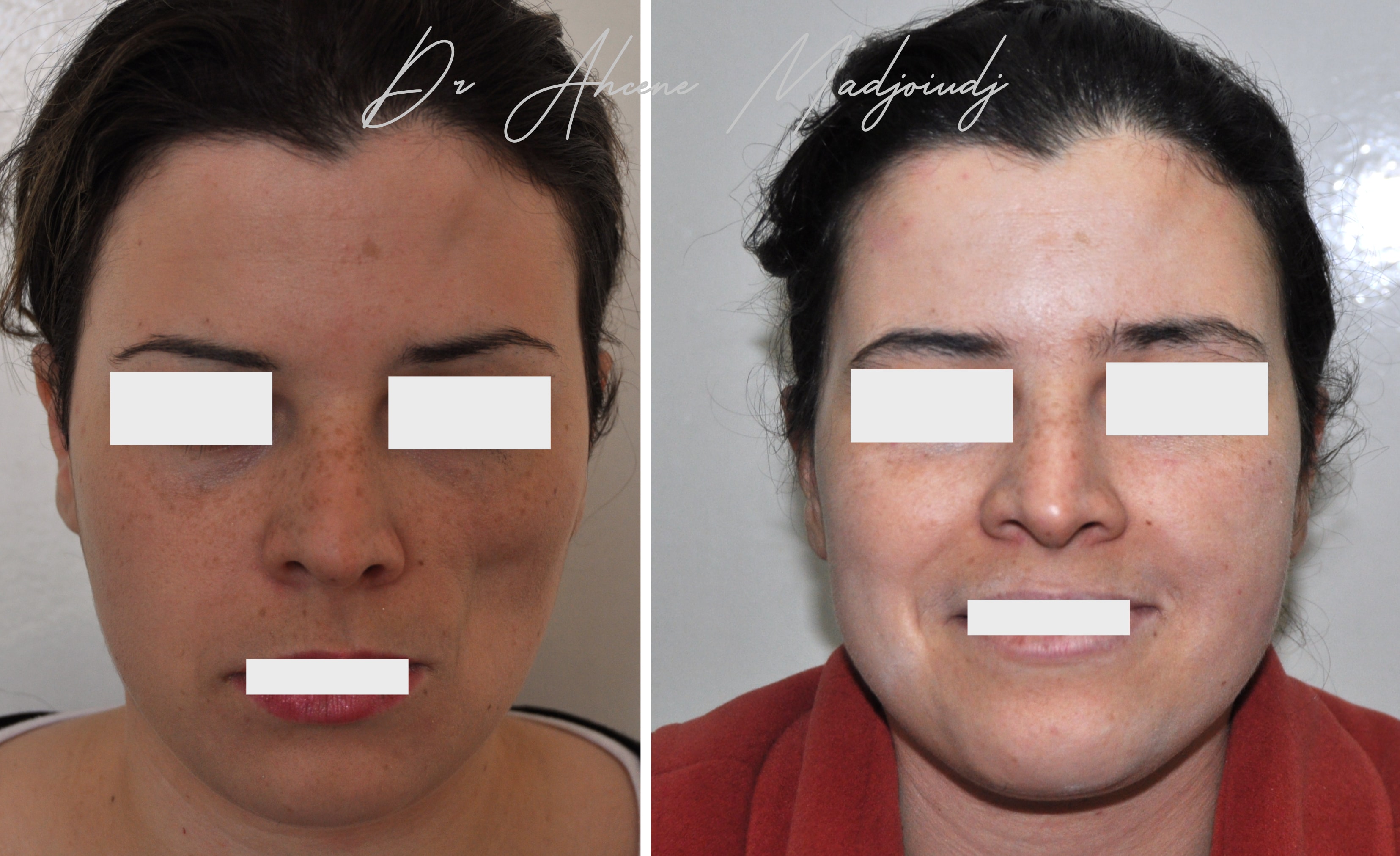 Lipofilling syndrome Parry-Romberg  ]à Alger, Algérie