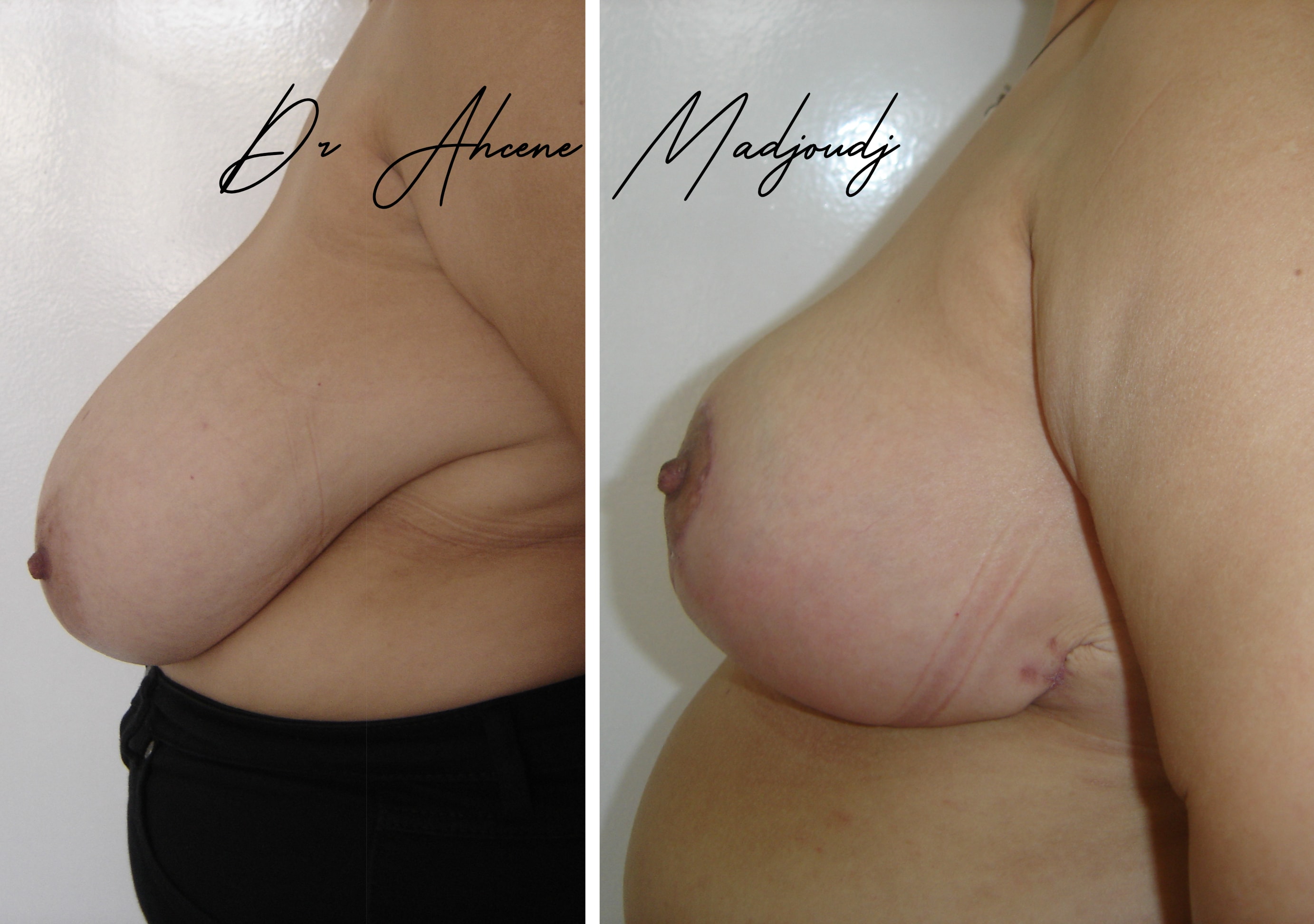 Réduction Mammaire en Algerie par  Le Docteur Madjoudj