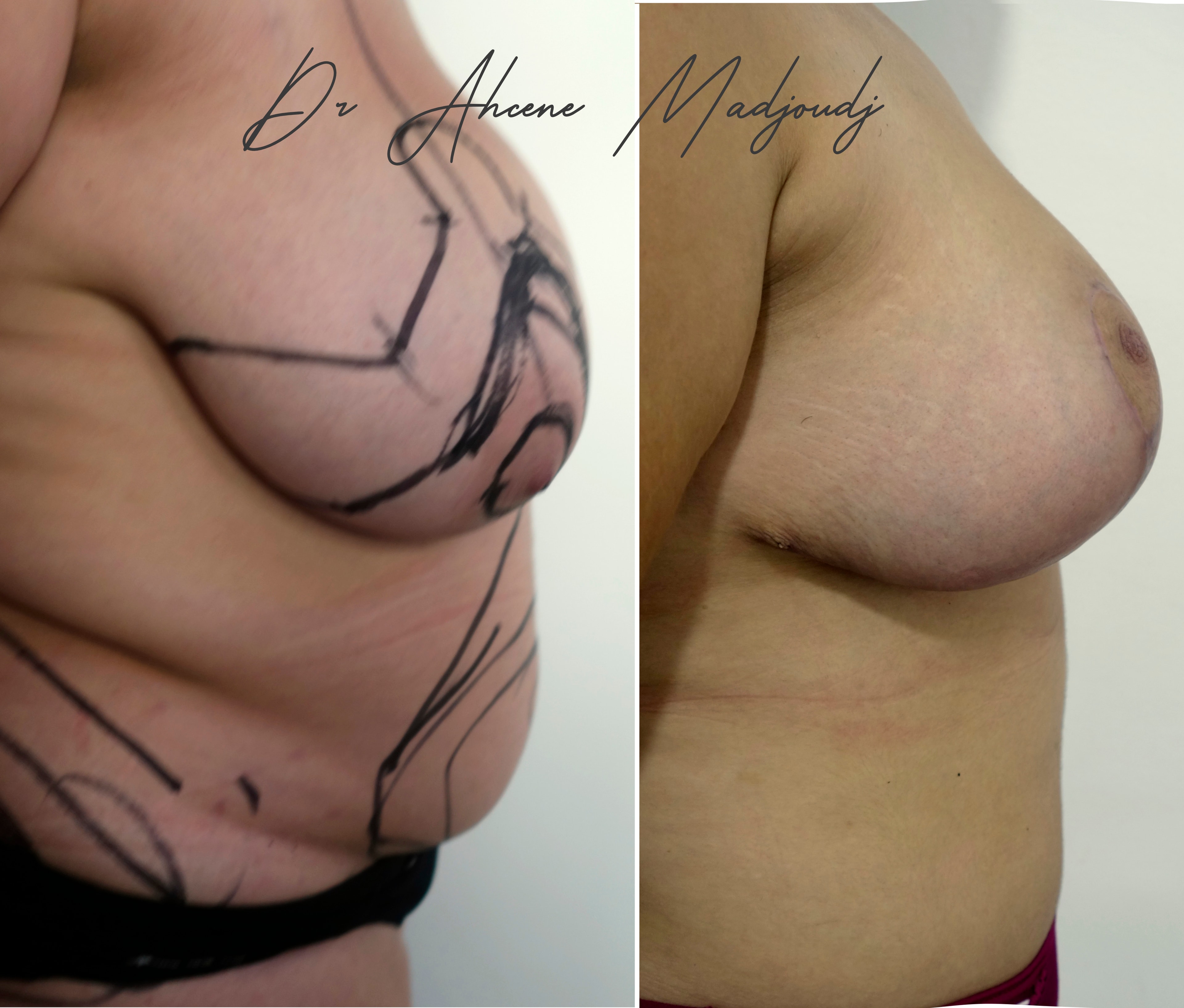 Chirurgie Post-Grossesse ou Mommy Makeover à Algerie