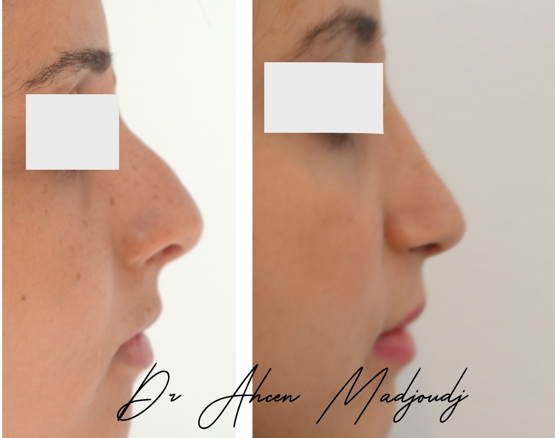 rhinoplastie en Algerie  par le Dr Ahcène Madjoudj 