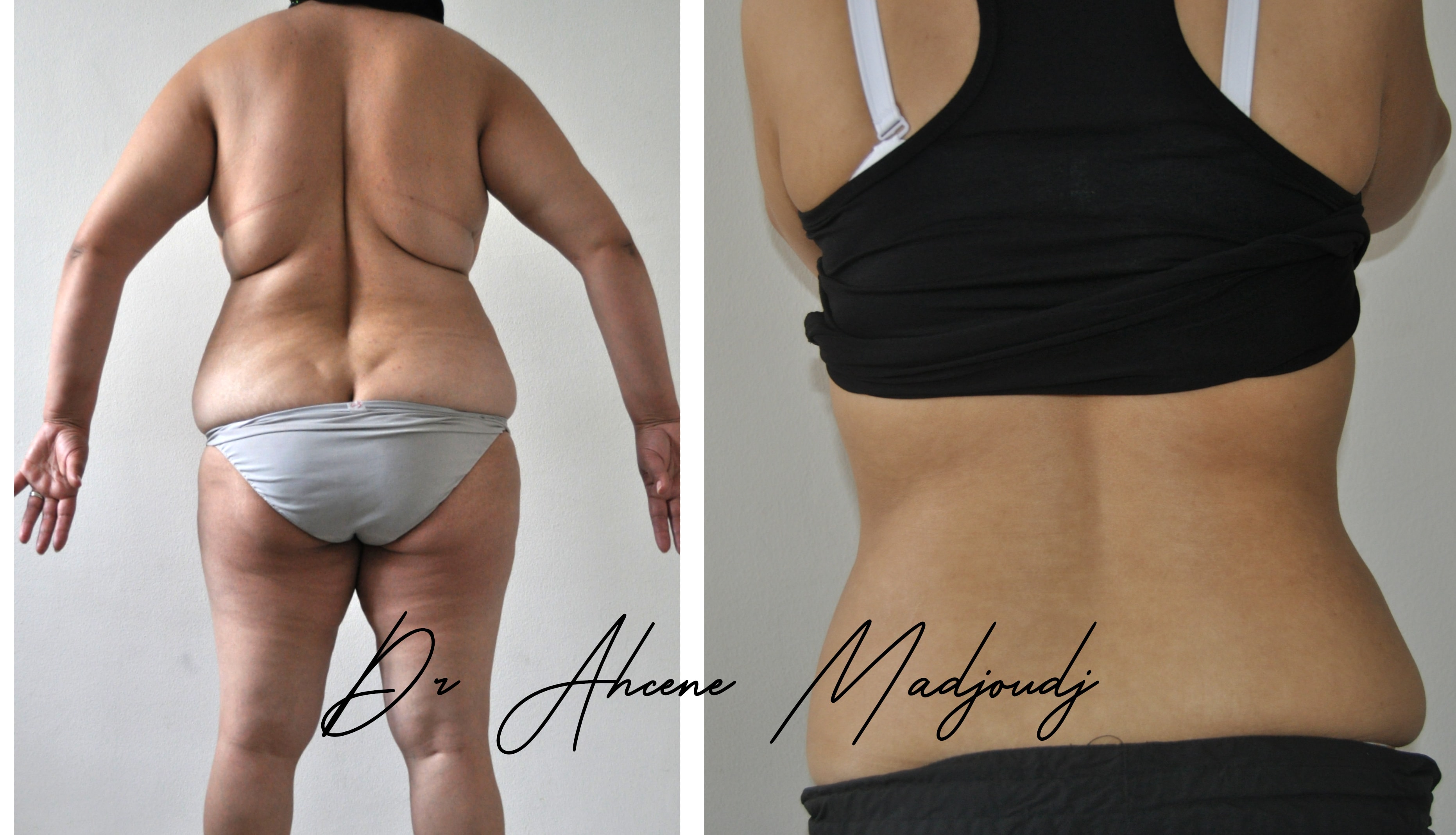 Liposuccion & Liposculpture à Alger par Le docteur Madjoudj