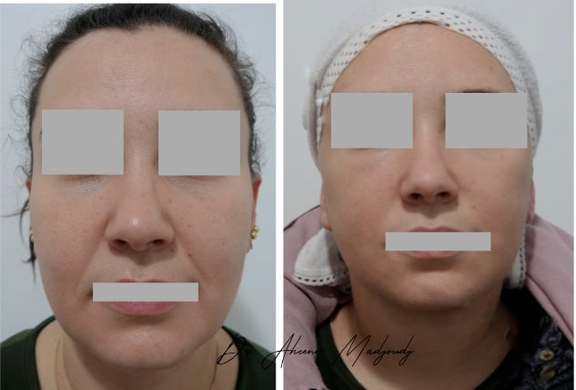 Lifting du Visage à Alger lifting-femme-jeune-avant-apres