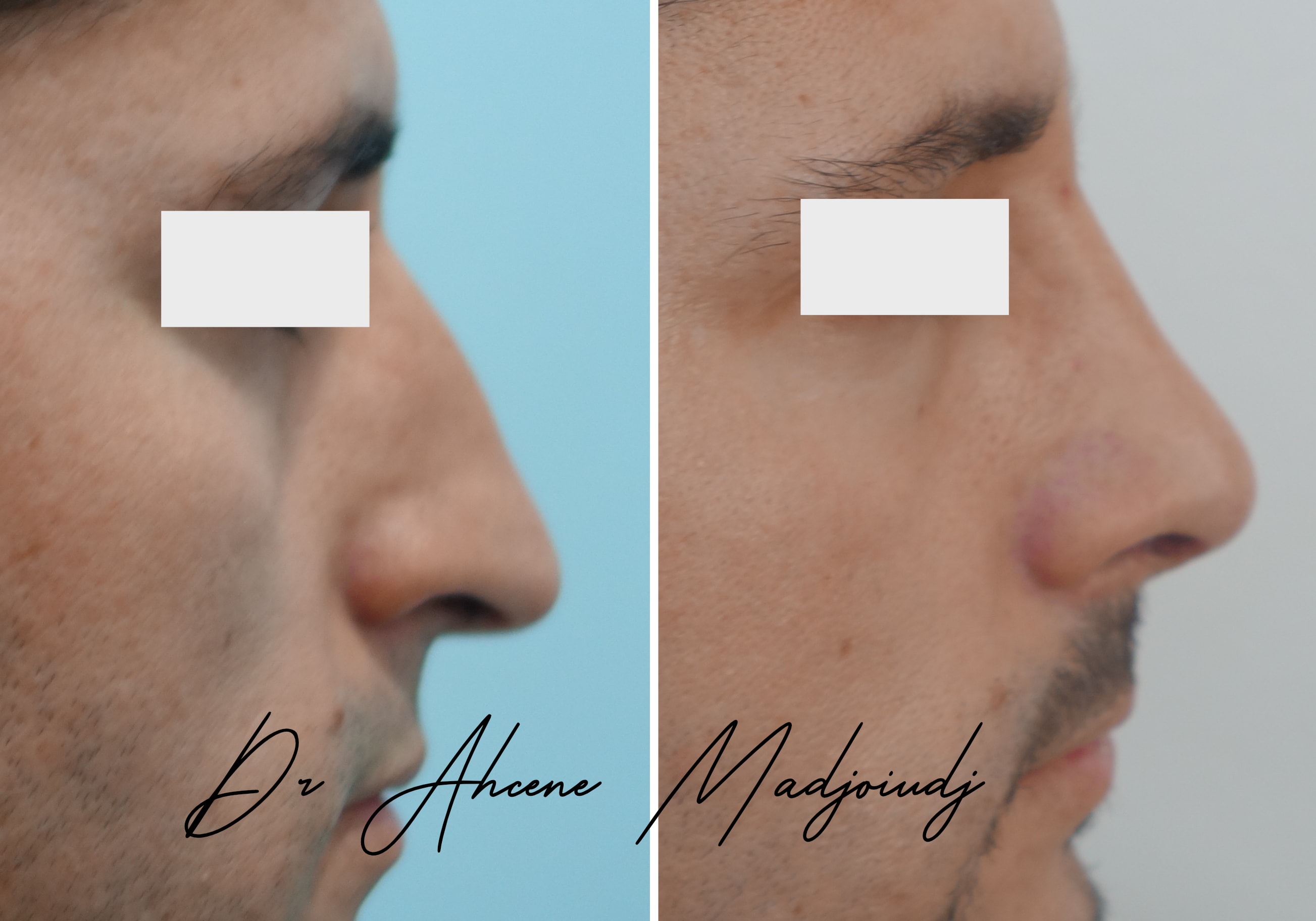rhinoplastie en Algerie  par le Dr Ahcène Madjoudj 