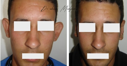 Otoplastie à Alger par le Dr Madjoudj 