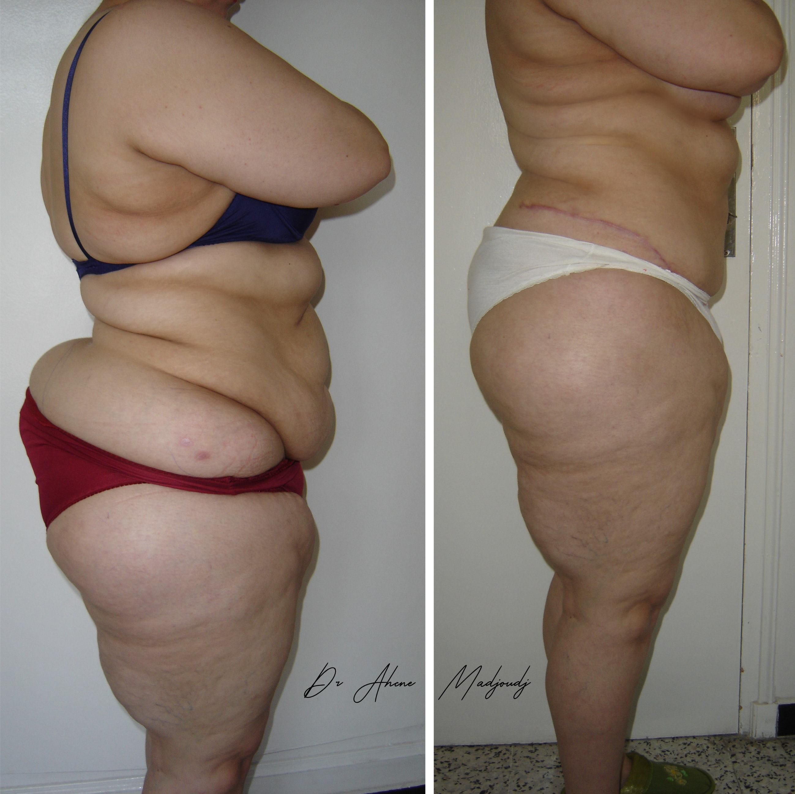 Liposuccion & Liposculpture à Alger par Le docteur Madjoudj