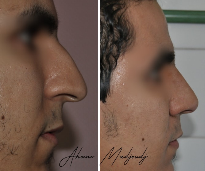 rhinoplastie-bourbon-1.jpg