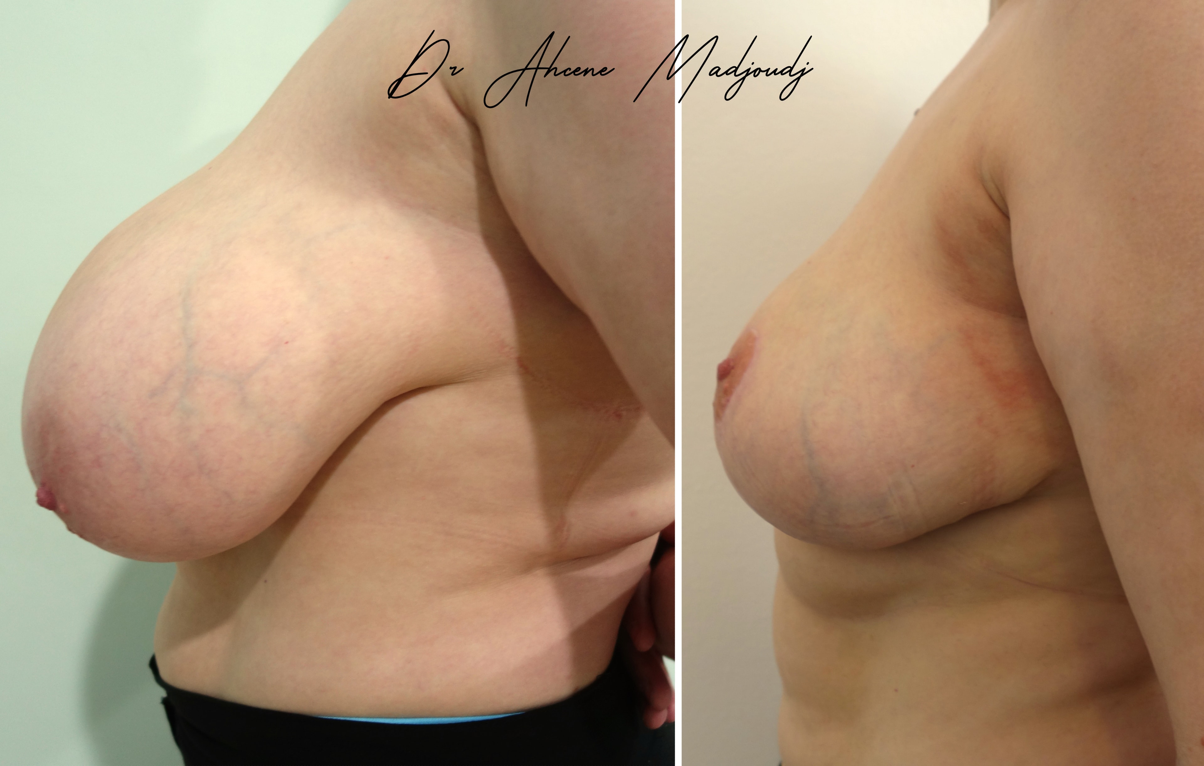 Réduction Mammaire en Algerie par  Le Docteur Madjoudj