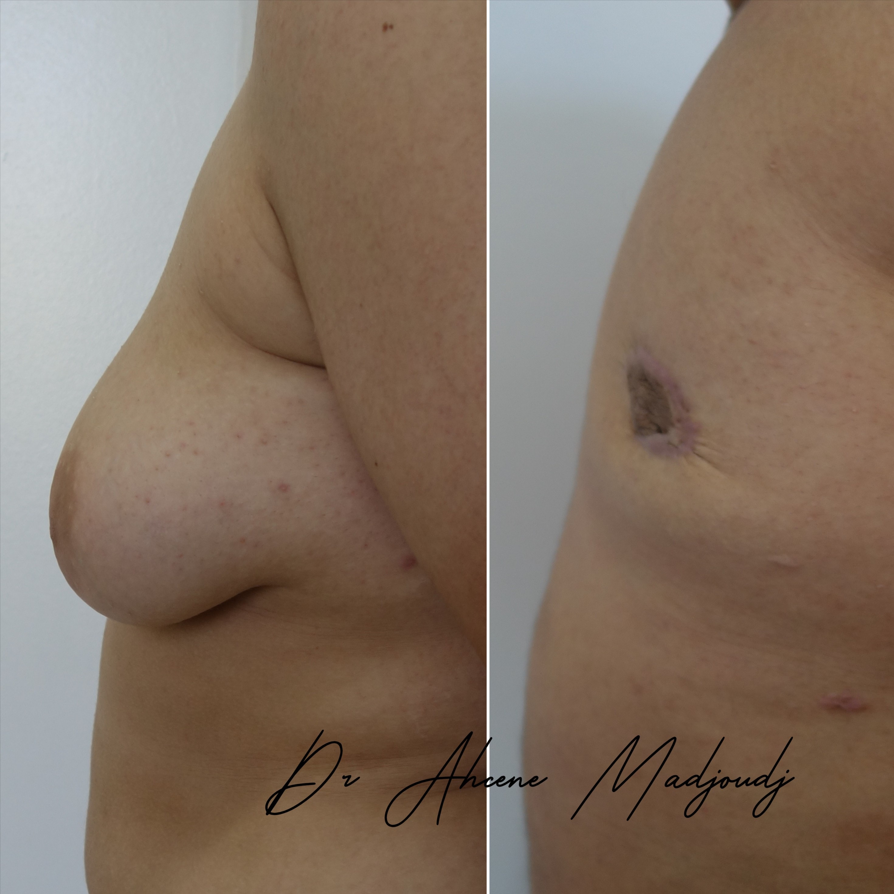 traitement de la gynécomastie sévère   par le docteur Madjoudj 