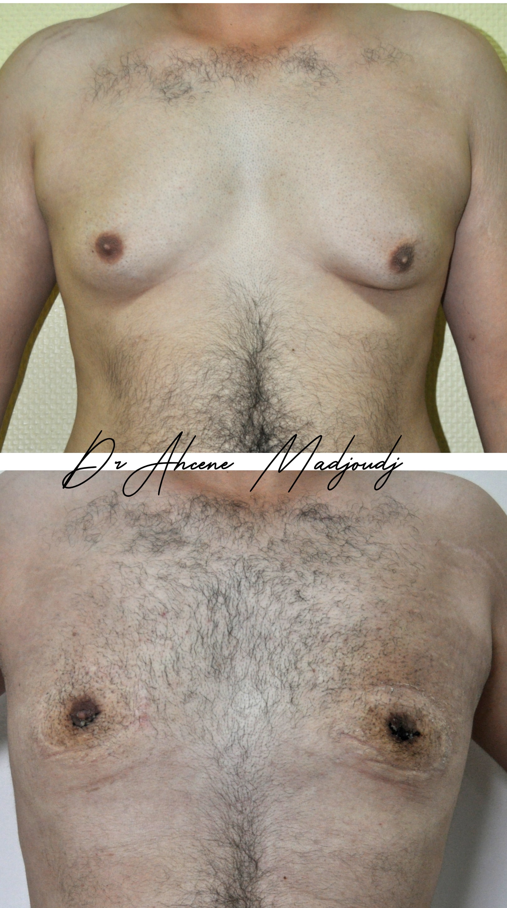 Traitement de la Gynécomastie modérée en Algérie