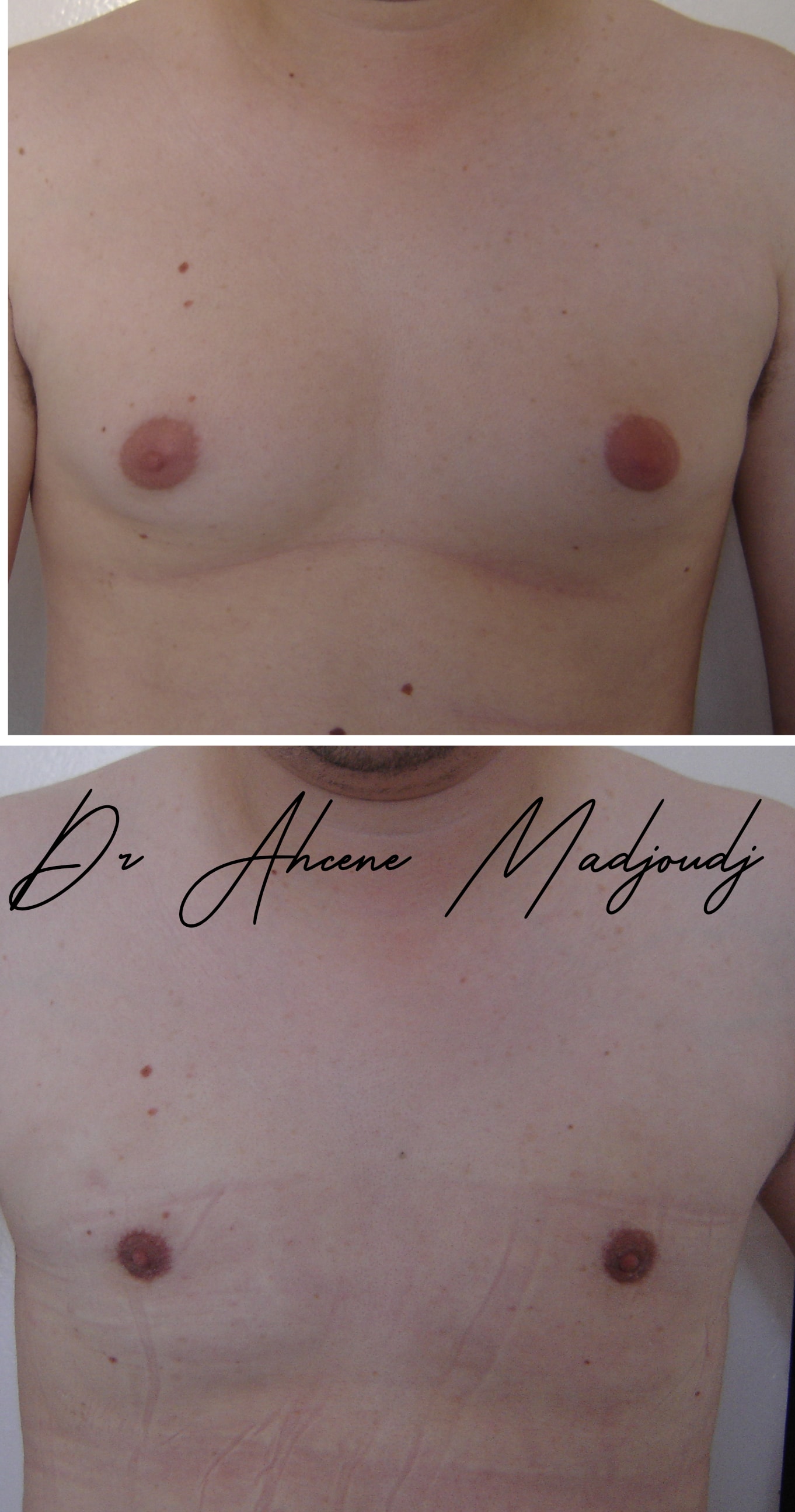 Traitement de la Gynécomastie modérée en Algérie