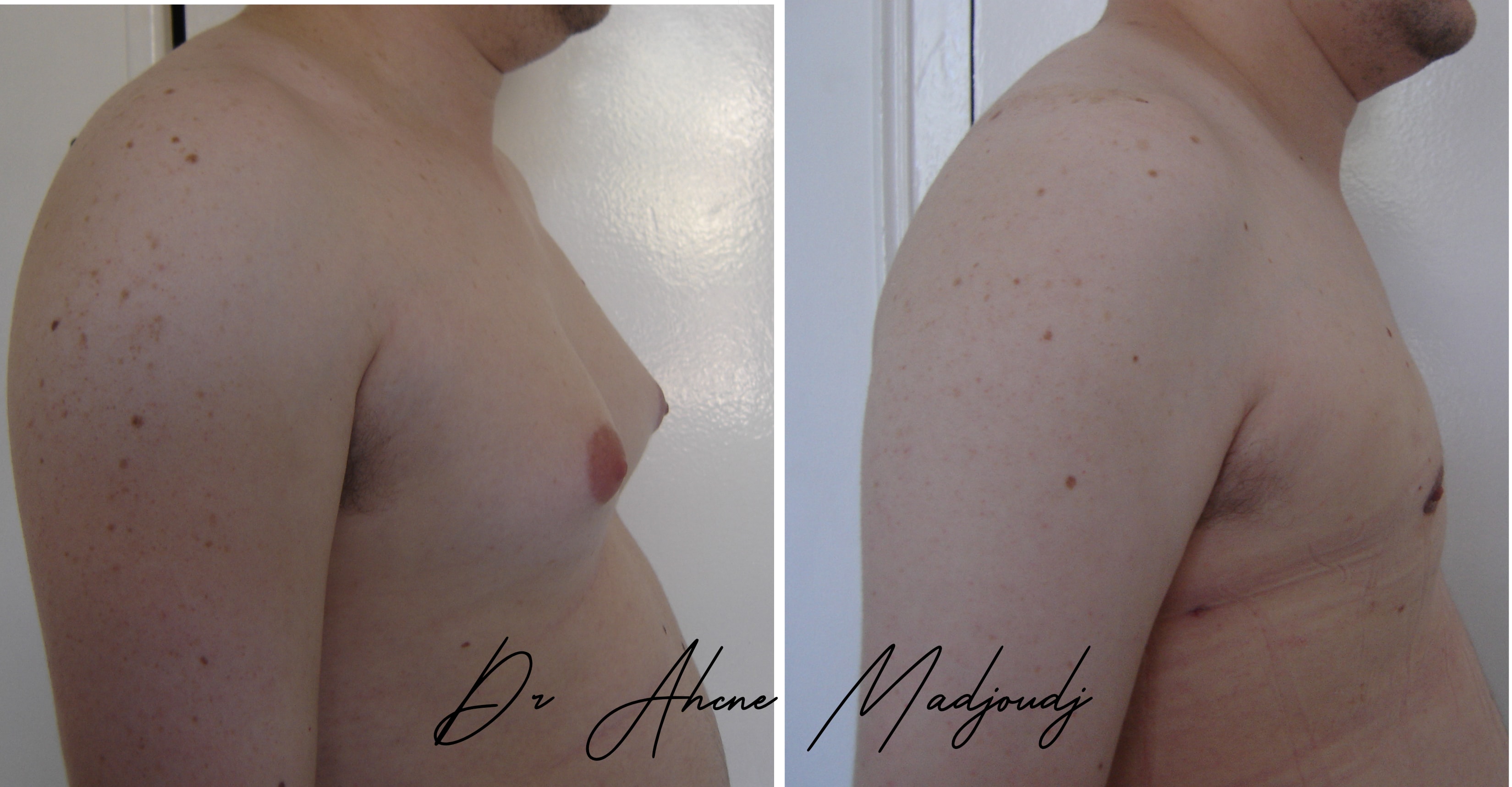 Traitement de la Gynécomastie modérée en Algérie